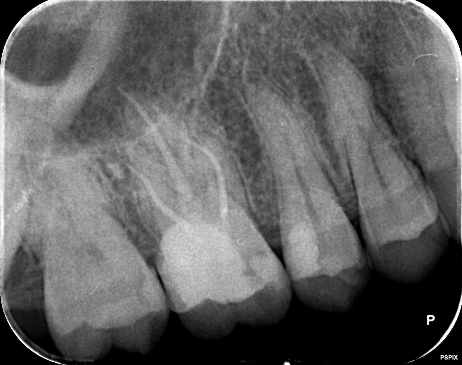 術後レントゲン